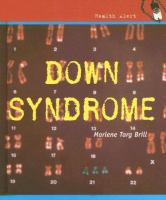 Down_syndrome